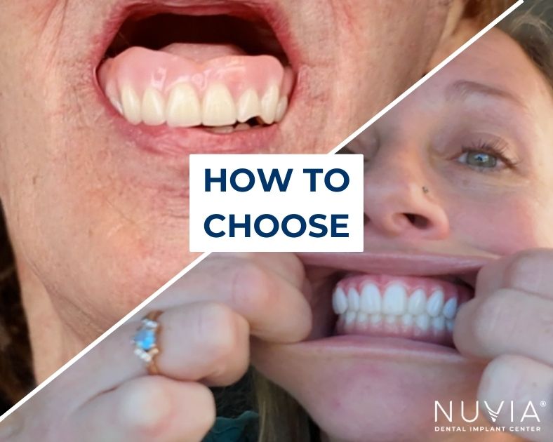 Affordable Dentures And Implants Which Is Right For You How To Choose Between Affordable Dentures And Dental Implants